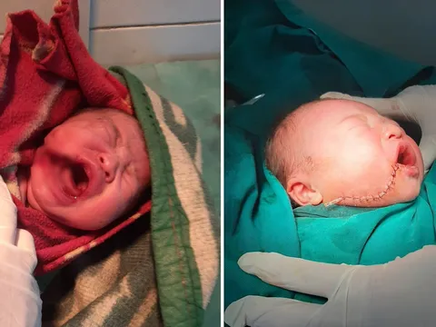 Mẹ tự đẻ tại nhà, bé gái sơ sinh bị rơi vào dao khiến môi và má rách sâu